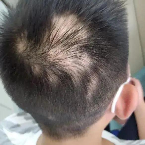 12歲男孩，學(xué)到頭禿